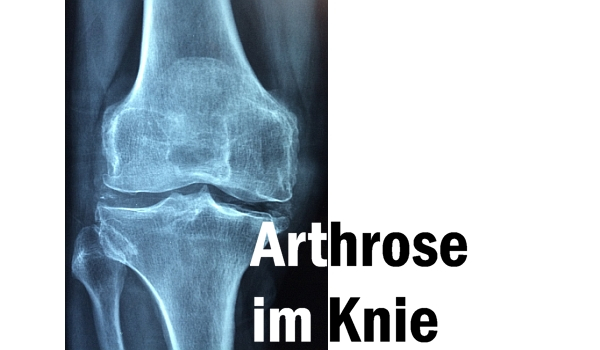 Was Tun Bei Arthrose Info Im Klinikum Straubing Regio Aktuell24